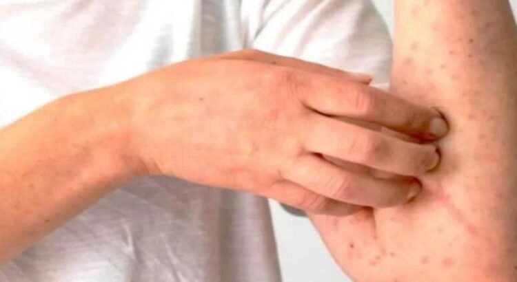 Se confirma el brote de 20 casos de sarampión en el estado de Coahuila Se confirma el brote de 20 casos de sarampión en el estado de Coahuila